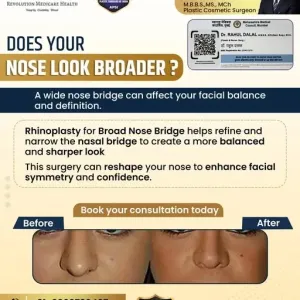 Broad-noser-hinopllasty-in-pune