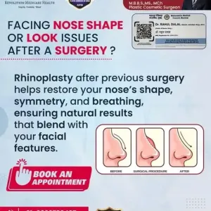 Nose-Surgery-Rhinoplasty-Expert-in-pune