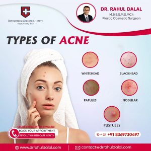 RAHUL-DALAL-SOCIAL-MEDIA-POST-OF-TYPES-OF-ACNE-1-scaled