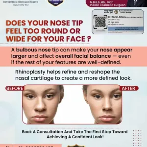 Rhinoplasty-Nose-Surgery-In-Pune