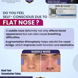 Saddle-Nose-Surgery-In-Pune