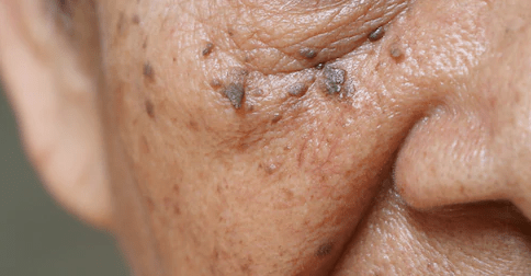 Facial lesions