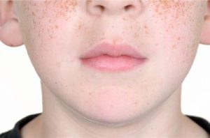 freckles