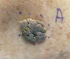 seborrheic keratoses