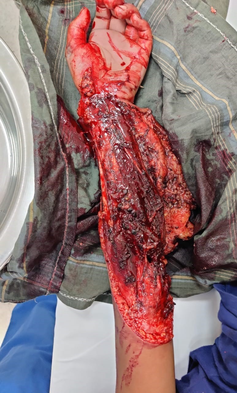 Vascular Injuries