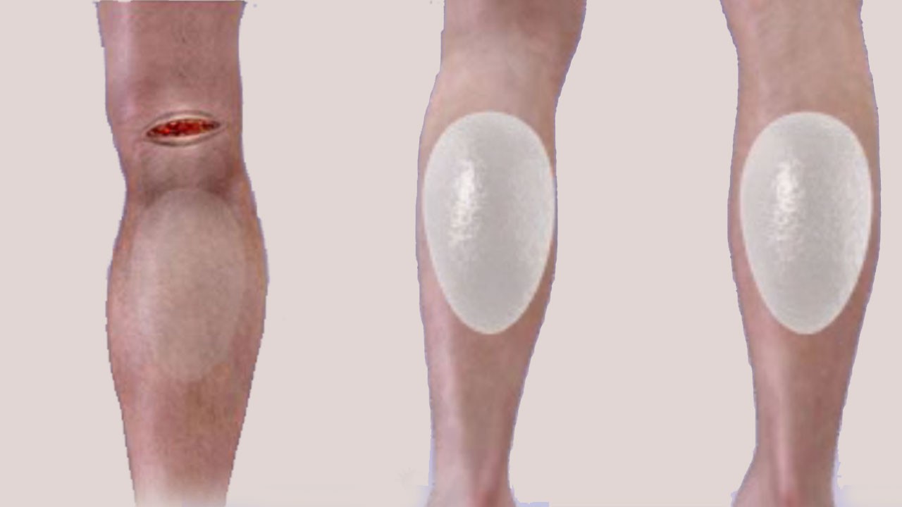 calf-implants