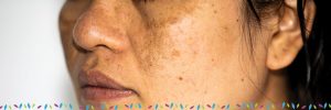 hyperpigmentation