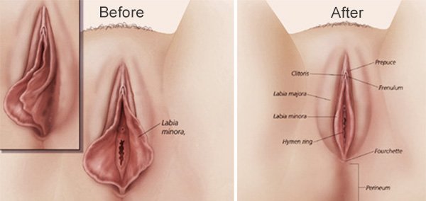 labiaplasty
