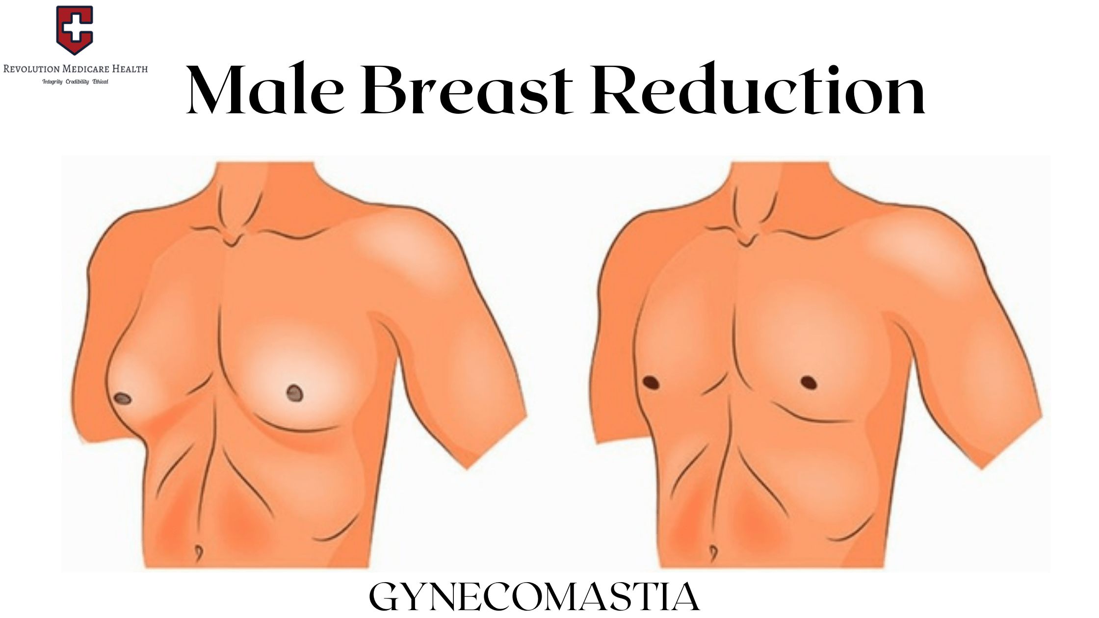 Male breast reduction Surgery by Dr. Rahul Dalal