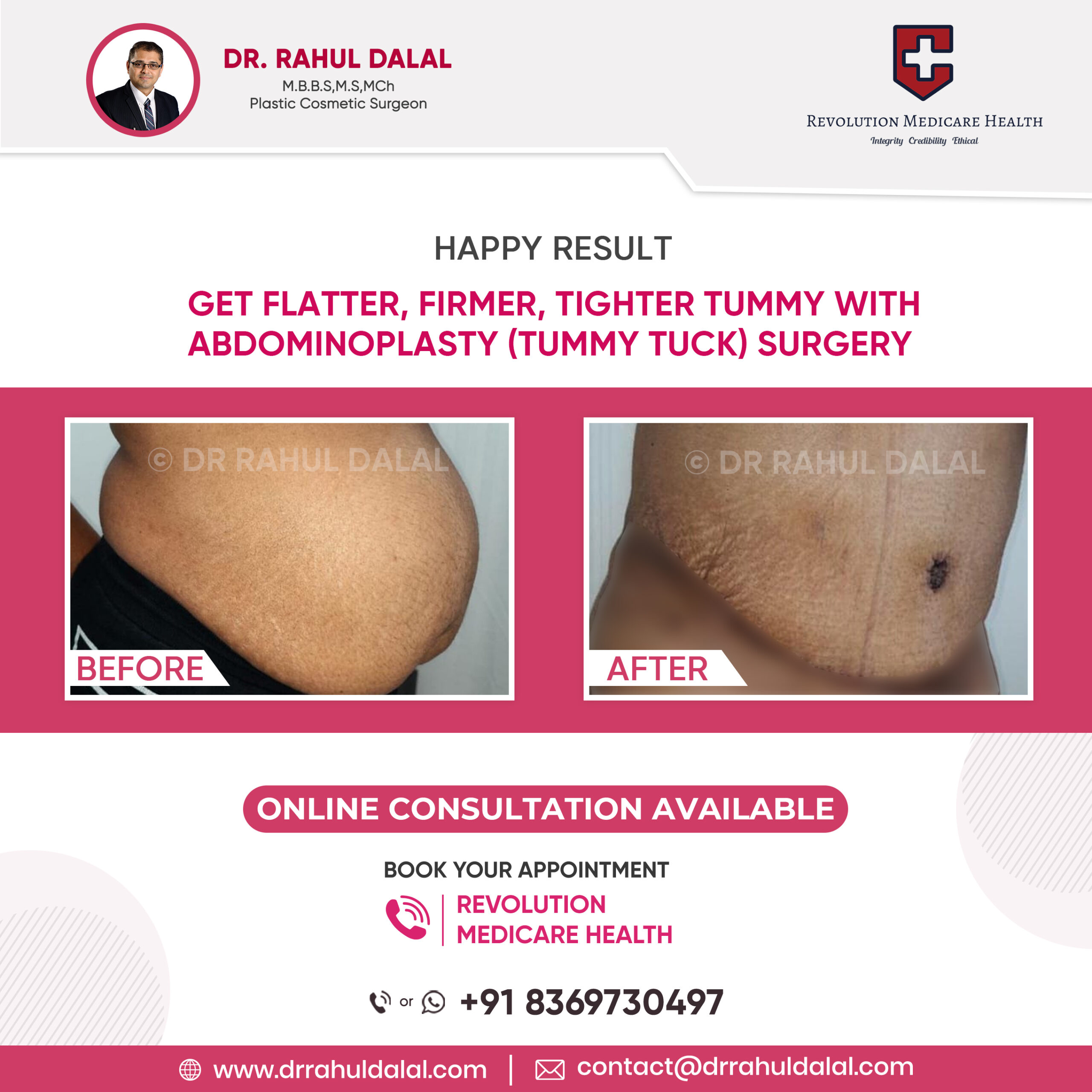 Best tummy tuck surgery in Pune