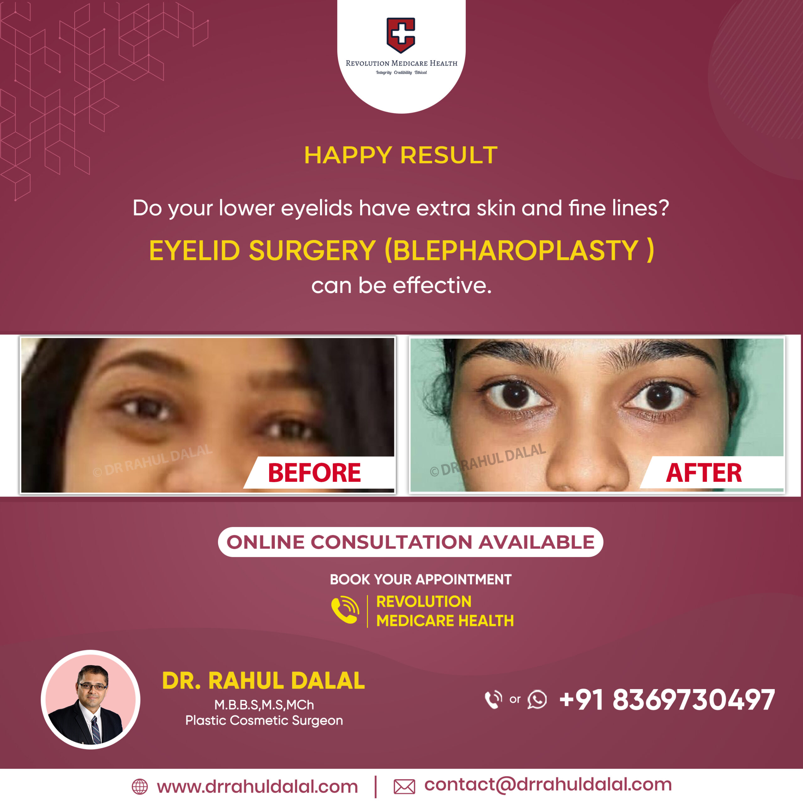 Best eyelid surgery in Pune-Dr.Rahul Dalal