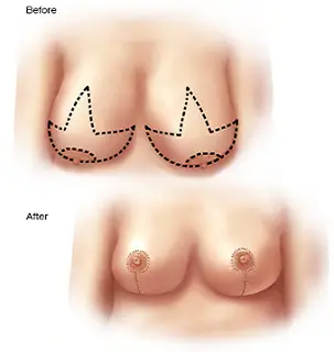 Best breast surgeon in Pune | Dr. Rahul Dalal